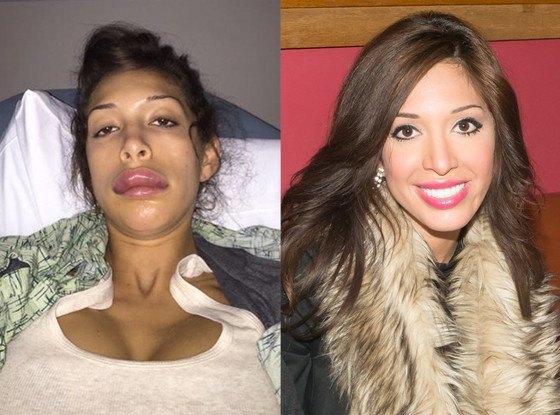 lip surgery complication farrah abraham before and after