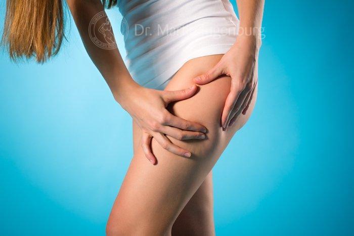 cellulite treatment cures woman grabbing thigh