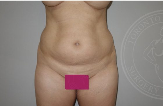 Plastic surgery liposuction before and after