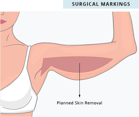 sixsurgery toronto arm lift surgical markings diagram