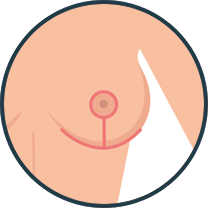 breast lift mastopexy diagram anchor incision