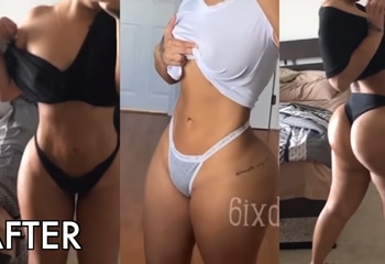 sixsurgery toronto BBL Brazilian Butt Lift before and after