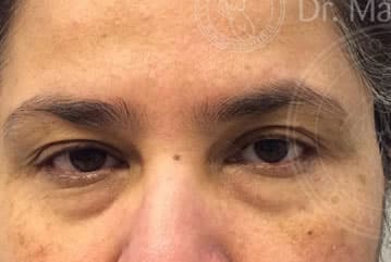 sixsurgery toronto eyelid blepharoplasty before and after