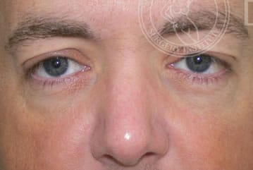 sixsurgery toronto eyelid blepharoplasty before and after