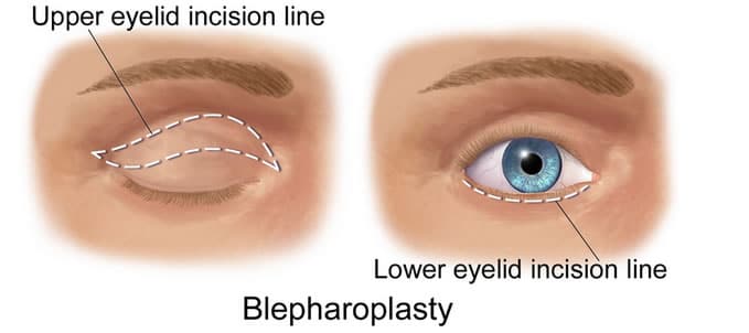 eyelid blepharoplasty clip art
