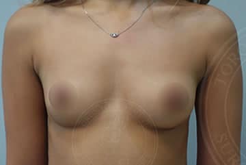 sixsurgery toronto breast augmentation before and after