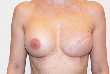 sixsurgery toronto breast reconstruction before and after