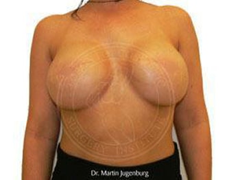 sixsurgery toronto breast reconstruction before and after