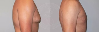 sixsurgery toronto male liposuction before and after