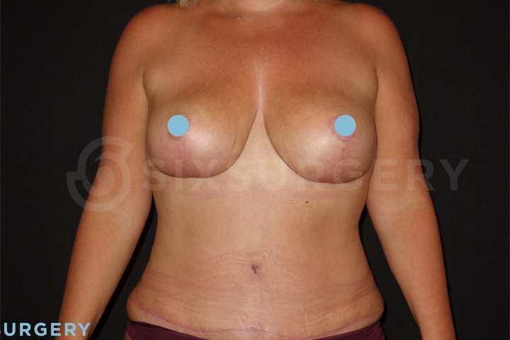 Dr constantine breast lift mastopexy before and after