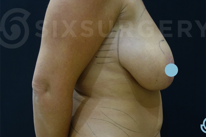 Dr constantine breast lift mastopexy before and after