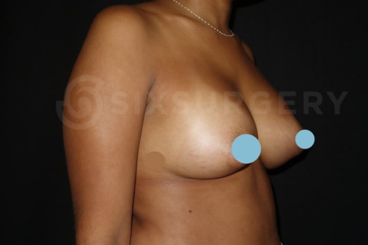 Dr Martin Jugenburg toronto breast augmentation implants before and after