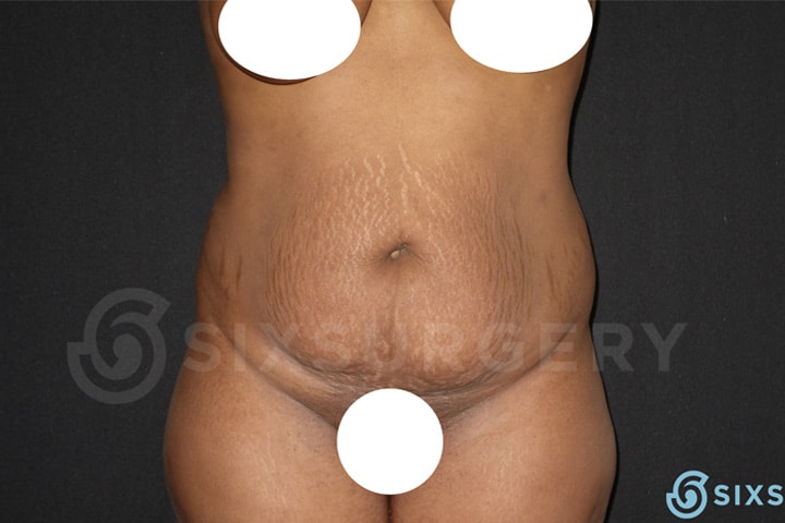 Dr Martin jugenburg toronto tummy tuck abdominoplasty before and after