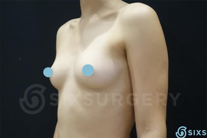 Dr Martin Jugenburg breast augmentation implants before and after toronto