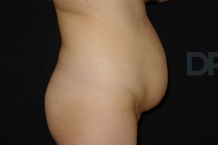 Dr Martin jugenburg tummy tuck abdominoplasty before and after