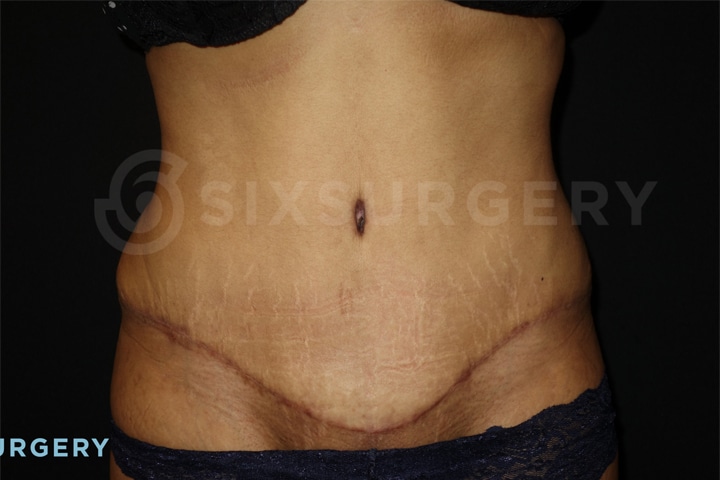 Dr rose makerewich tummy tuck abdominoplasty before and after