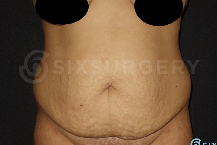 sixsurgery toronto tummy tuck abdominoplasty before and after