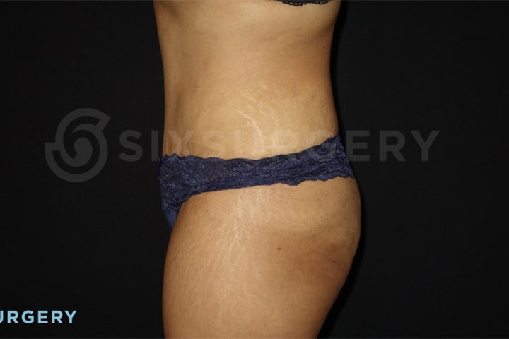 Dr rose makerewich tummy tuck abdominoplasty before and after