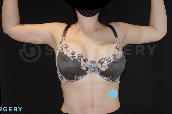 Dr rose makerewich mommy makeover tummy tuck abdominoplasty arm lift brachioplasty before and after