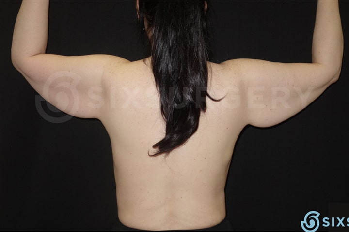 Dr rose makerewich arm lift brachioplasty before and after