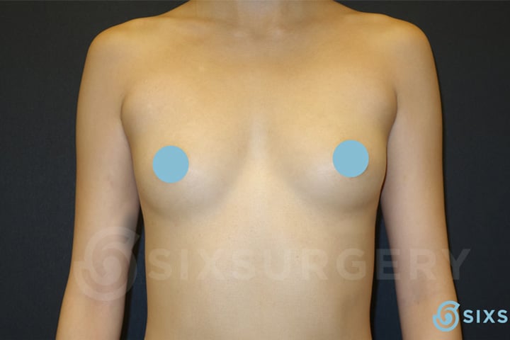 Dr rose makerewich breast augmentation implants before and after