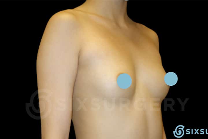 Dr rose makerewich breast augmentation implants before and after