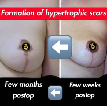 sixsurgery breast lift mastopexy scar healed before and after