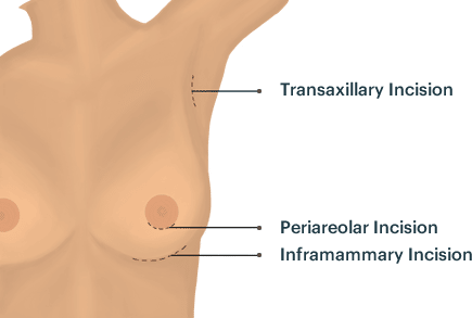 breast augmentation incision sites diagram