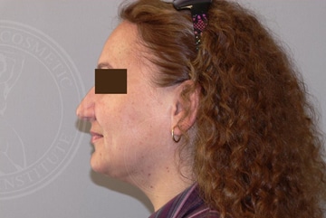 sixsurgery chin toronto chin liposuction before and after