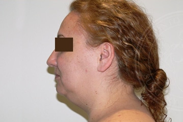 sixsurgery chin toronto liposuction before and after