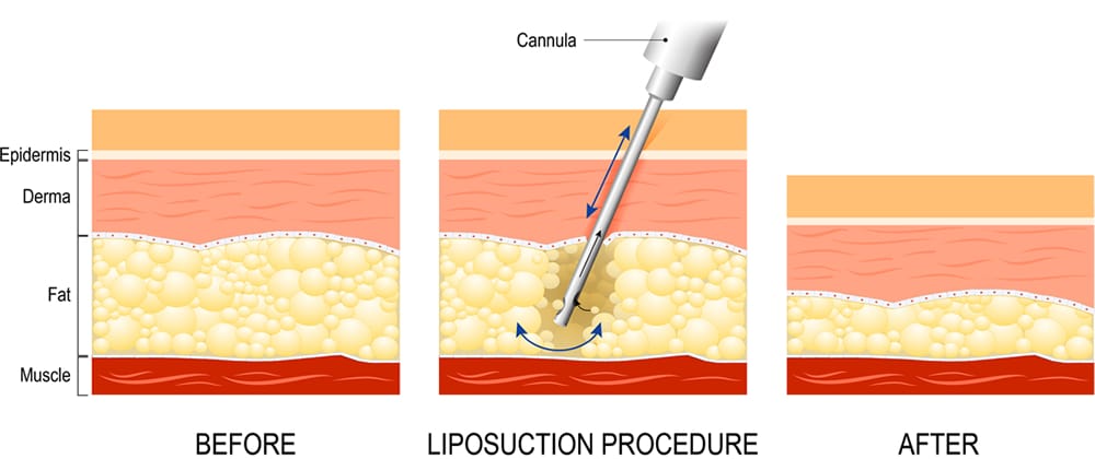 Liposuction procedures