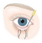 eyelid blepharoplasty clip art
