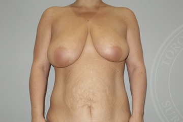 sixsurgery toronto mommy makeover breast lift mastopexy before and after