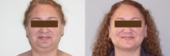 sixsurgery toronto face liposuction before and after