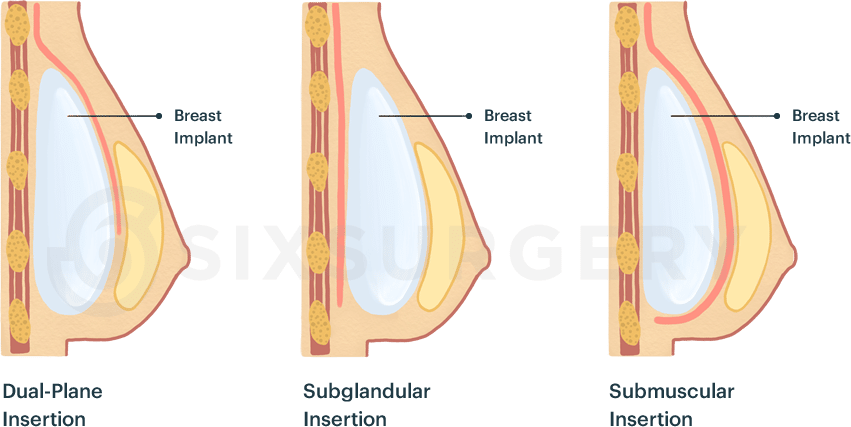 breast augmentation breast implant over and under the muscle placement diagram
