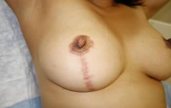 sixsurgery breast lift mastopexy scar healed before and after