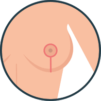 breast lift mastopexy diagram lollipop incision