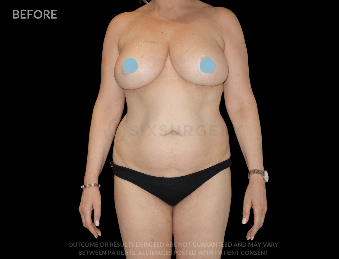 before and after mommy makeover tummy tuck liposuction - six surgery - TCSI - toronto