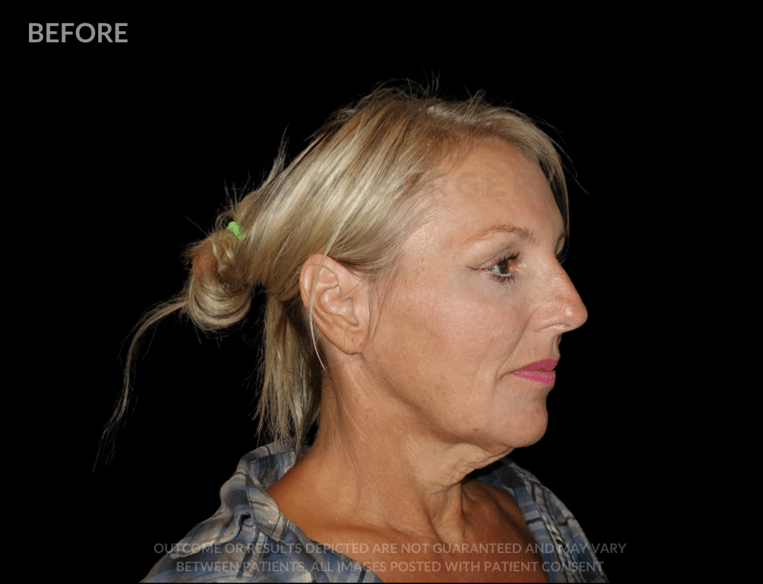 before and after - facelift - six surgery - toronto - Dr 6ix