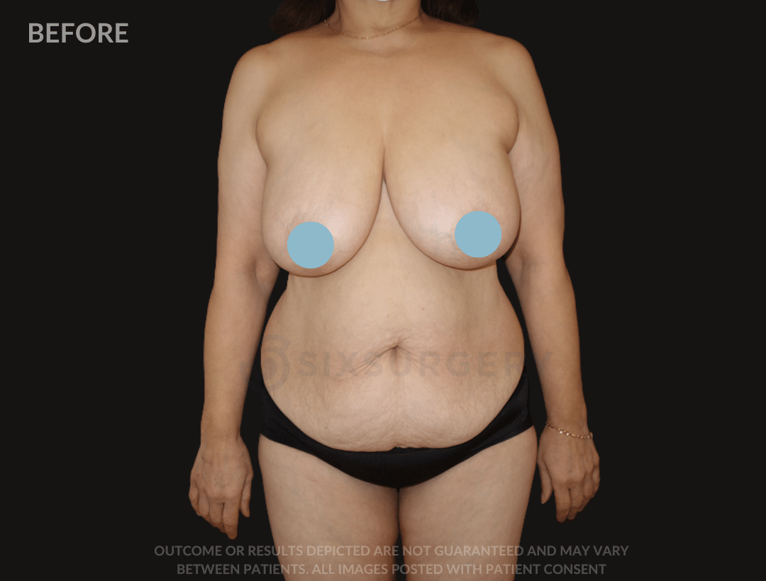 six surgery before and after breast reduction tummy tuck mommy makeover