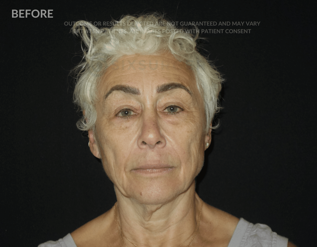 sxisurgery facelift befoer and after