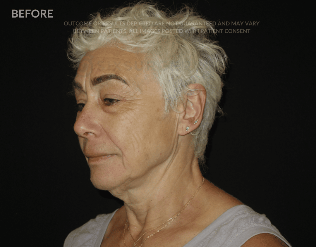 sxisurgery facelift befoer and after