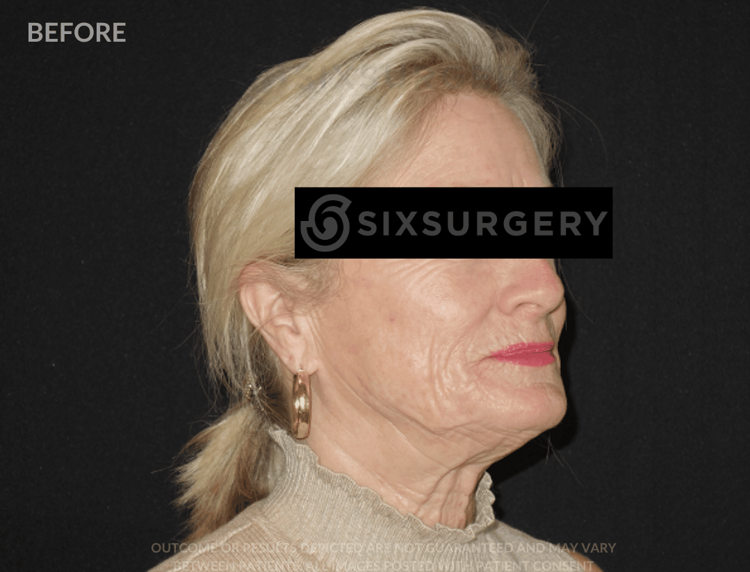 sixsurgery facelift before and after