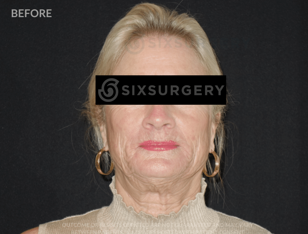 sixsurgery facelift before and after