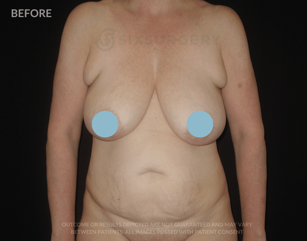 sixsurgery Mommy Makeover before and after