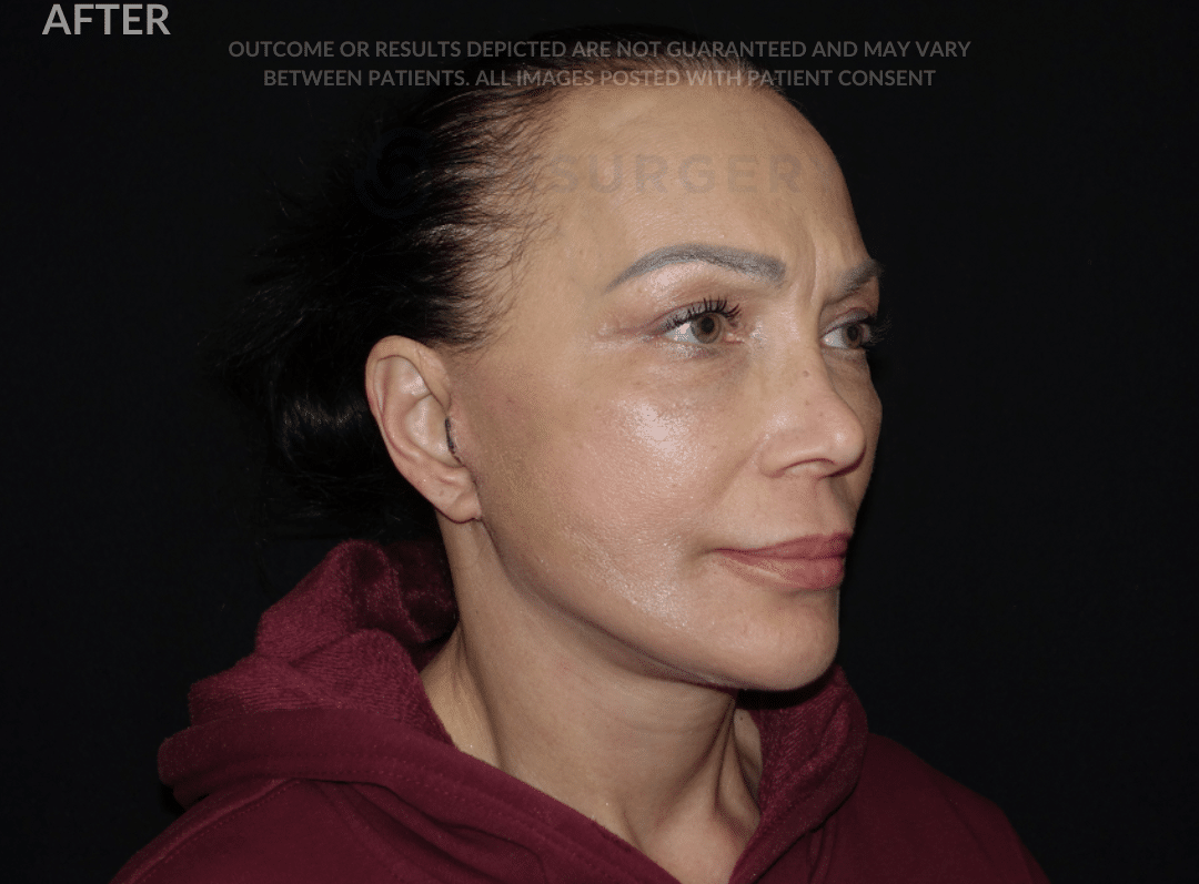 Before and after facelift - toronto - six surgery - Dr 6ix