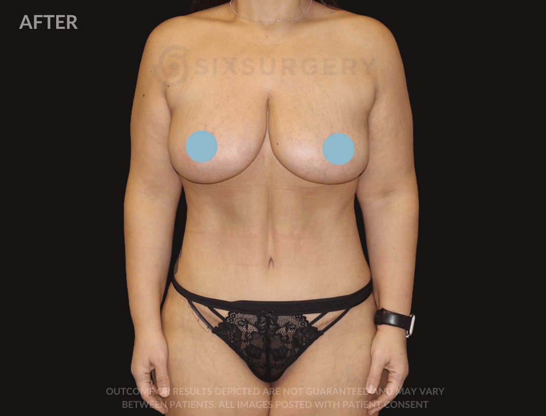 sixsurgery mommy makeover mastopexy breast lift tummy tuck liposuction before and after