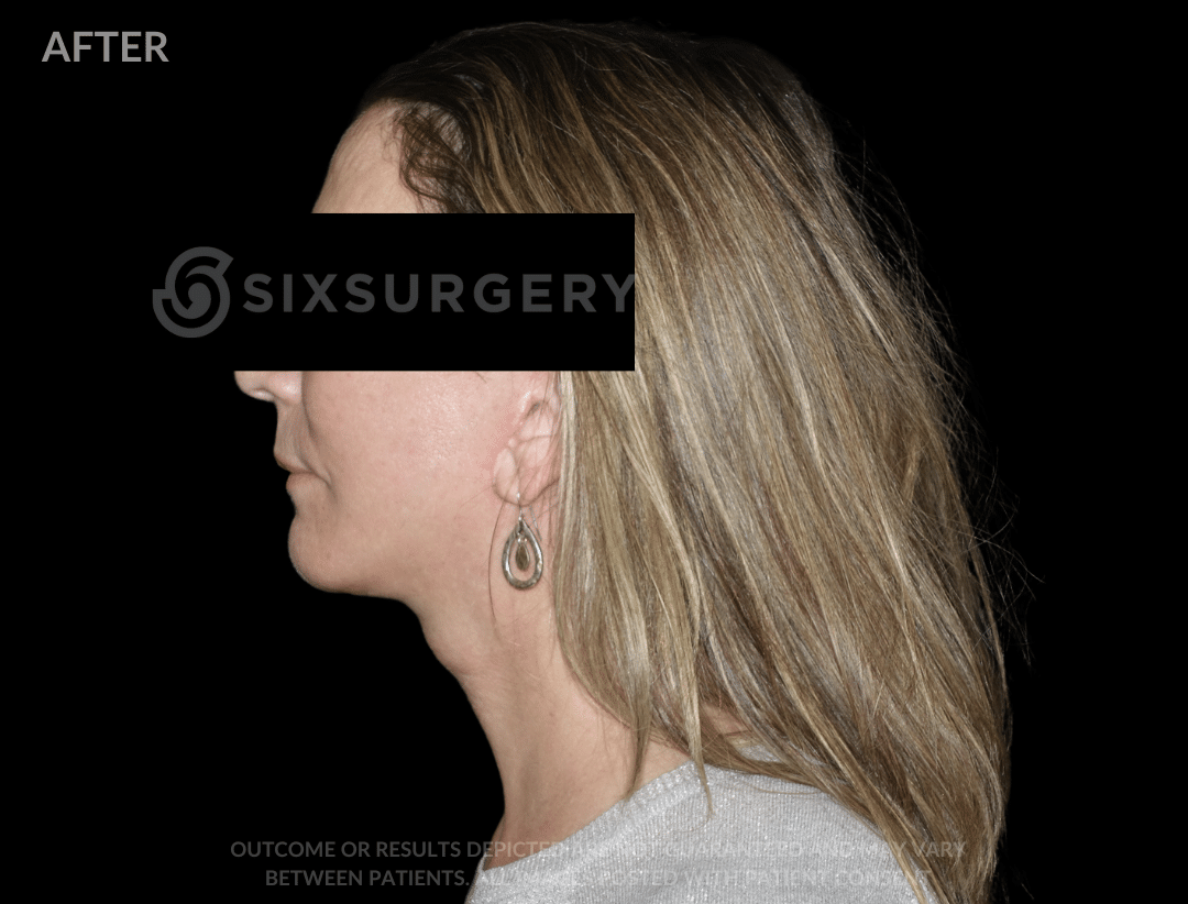 before and after facelift - six surgery - toronto - Dr 6ix