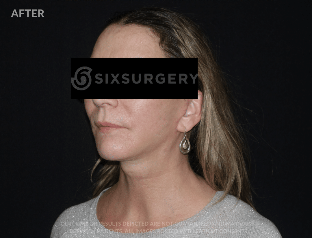 before and after facelift - six surgery - toronto - Dr 6ix
