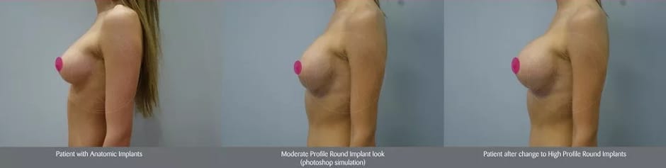 Sixsurgery Implant Shape Profile